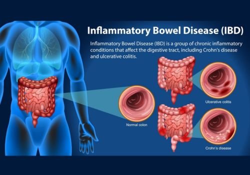 Inflammatory Bowel Disease