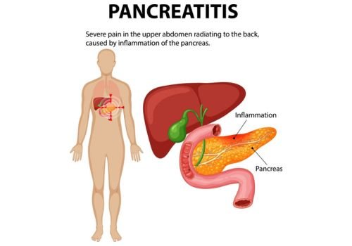 Pancreatitis