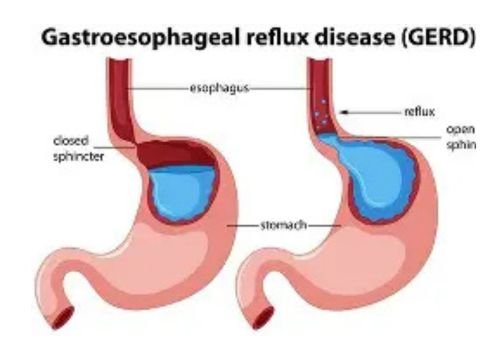 GERD 