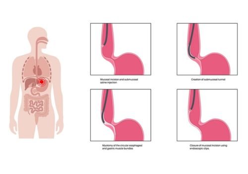 Third Space Endoscopy